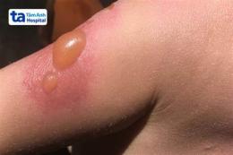 ảnh chụp màn hình bỏng nước sôi phồng da