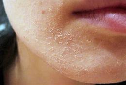ảnh chụp màn hình da quanh miệng bị khô bong tróc