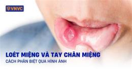 ảnh chụp màn hình da trong miệng bị bong