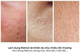 ảnh chụp màn hình dụng retinol bị bong da có nên dùng tiếp