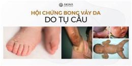 ảnh chụp màn hình hội chứng bong vảy da do tụ cầu