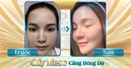 ảnh chụp màn hình meso căng bóng da