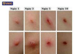 ảnh chụp màn hình mụn nước bỏng dạ và thủy đậu