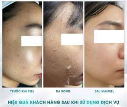 ảnh chụp màn hình peel da không bong là gì