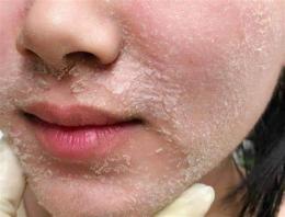 ảnh chụp màn hình peel da không bong tróc loại nào tốt