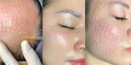 ảnh chụp màn hình tiêm căng bóng da mặt giá bao nhiêu