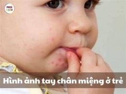 ảnh chụp màn hình trẻ bị bong da tay chân
