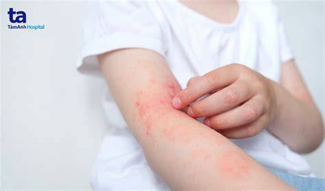 ảnh chụp màn hình viêm da bóng nước