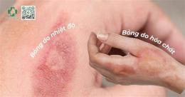 ảnh chụp màn hình xử lý vết bỏng bị tróc da