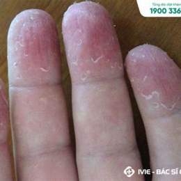 bé bị bong da đầu ngón tay