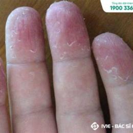 bị bong da ở đầu ngón tay là bệnh gì