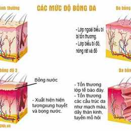 cách chữa bỏng dạ