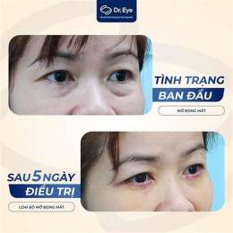 cách trị bọng mắt bằng nước đá