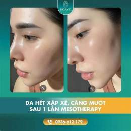 cấy meso căng bóng da