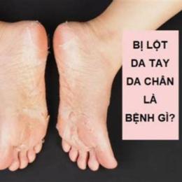 chân bị bong da là bệnh gì