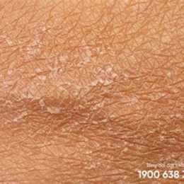 da bị bong tróc vảy trắng