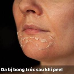da bong sau peel bị đỏ