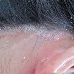 da đầu bị bong tróc từng mảng