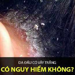da đầu bong tróc