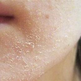 da mặt khô bong tróc nên dùng gì tại nhà