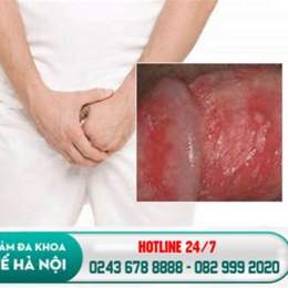 dương vật bị bong da