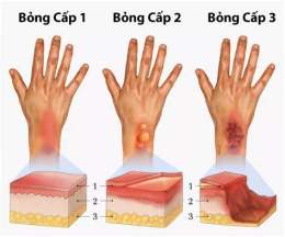 hướng dẫn sử dụng bệnh bỏng dạ