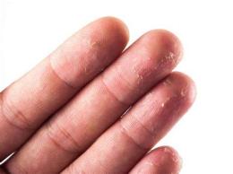 hướng dẫn sử dụng bong da tay là bị gì