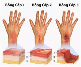 hướng dẫn sử dụng bỏng rộp da nên làm gì