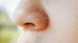 hướng dẫn sử dụng cánh mũi bị khô bong da