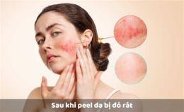 hướng dẫn sử dụng da bong sau peel bị đỏ