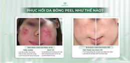 hướng dẫn sử dụng peel da bị bỏng nhẹ