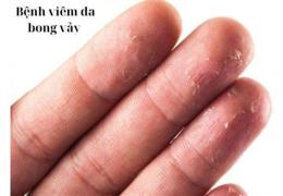 hướng dẫn sử dụng viêm da bong vảy