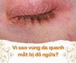 hướng dẫn sử dụng vùng da quanh mắt bị khô, bong tróc phải làm sao