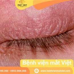 mí mắt bị khô bong da