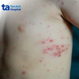 mụn nước bỏng dạ và thủy đậu