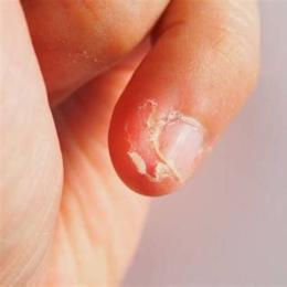 ngón tay bị bong da là bị gì