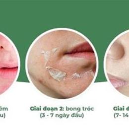 peel da mocha bao lâu thì bong