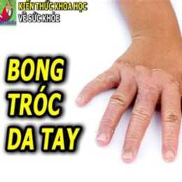 tay bị bong tróc da