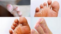 tính năng nổi bật bàn chân bị bong da