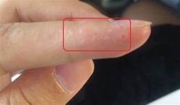 tính năng nổi bật bị bong da ở đầu ngón tay là bệnh gì