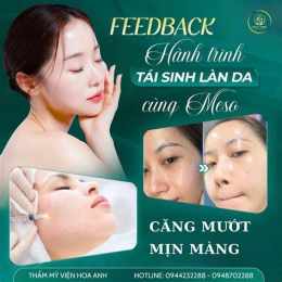 tính năng nổi bật cấy meso căng bóng da