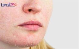 tính năng nổi bật da mặt bong tróc