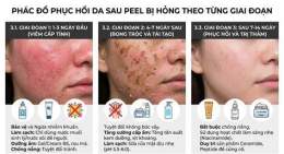 tính năng nổi bật peel da bị bỏng phải làm sao