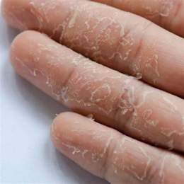 tính năng nổi bật tại sao da tay bị khô và bong tróc