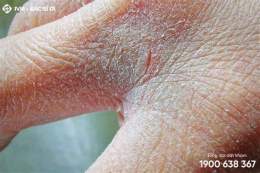 tính năng nổi bật tay bị bong da nhiều