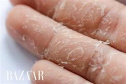 tính năng nổi bật tay bị bong da thiếu chất gì