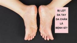 tính năng nổi bật tay chân bị bong da là bệnh gì