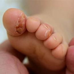 trẻ bị bong tróc da đầu ngón chân