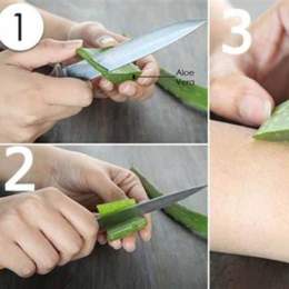 trị bỏng da bằng nha đam