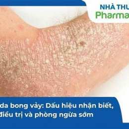 viêm da bong vảy